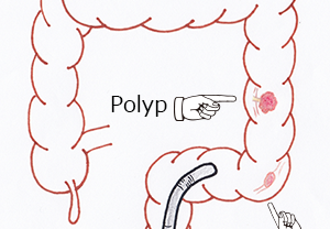 polyp